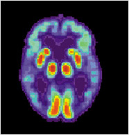 abnormal pet scan